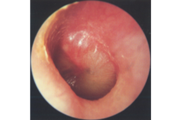 急性中耳炎　症状