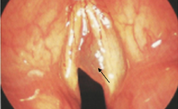 声帯ポリープ